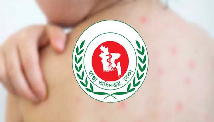হাম ও হামের উপসর্গে সাড়ে ৬ মাসে মৃত্যু হাজার ছাড়িয়েছে